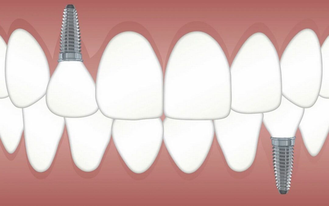 Esploriamo i Diversi Tipi di Impianti Dentali: Opzioni per il Sorriso Perfetto