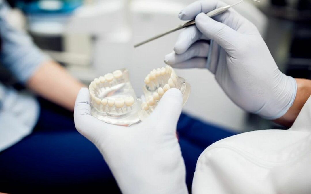 Cos’è un ponte dentale?  Esaminiamo i diversi tipi di ponti dentali.
