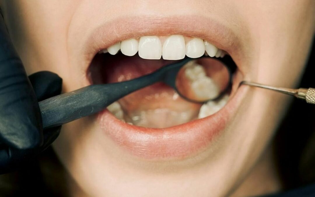 Estetica gengivale nelle protesi conometriche: Integrazione estetica con i tessuti molli